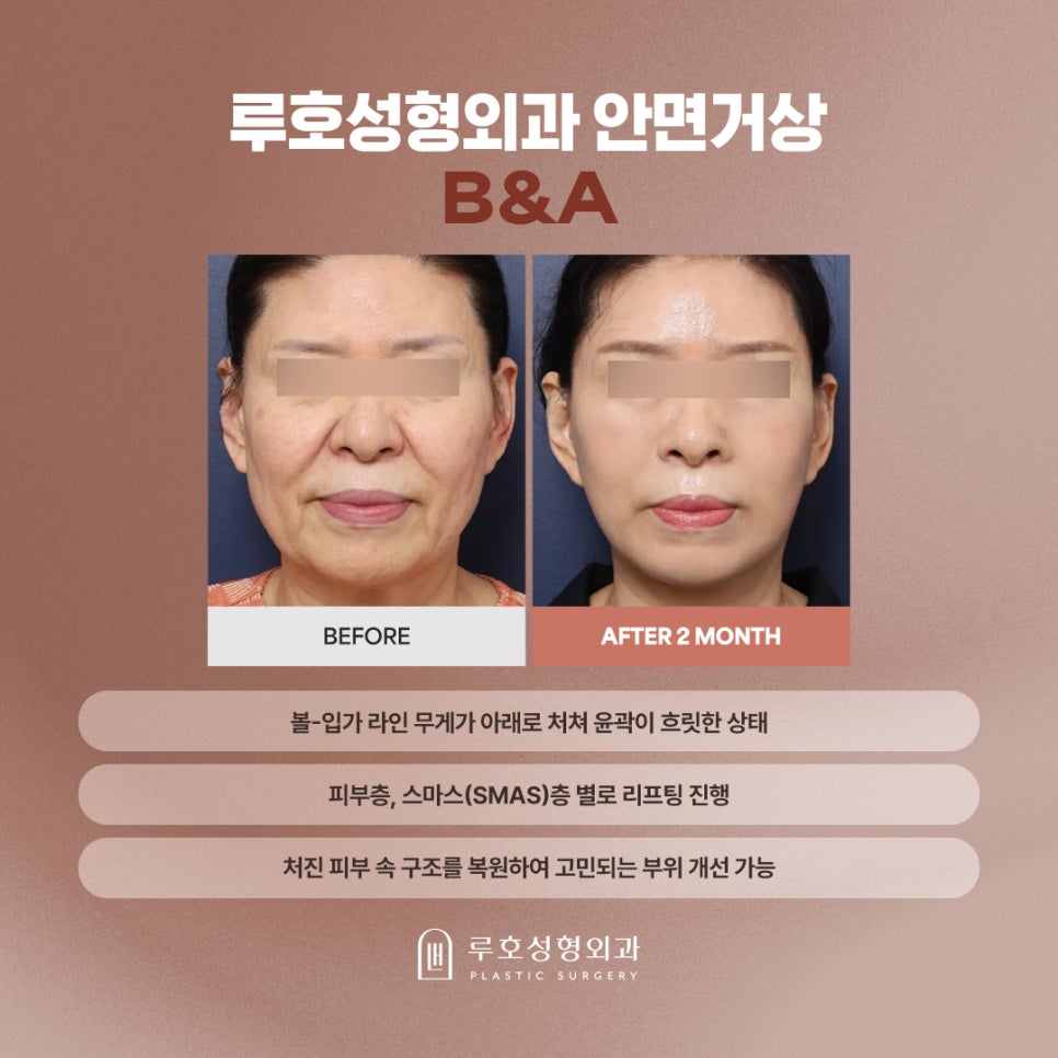Before and After Reveal of a Refined Jawline at a Place Known for Facelift Surgery Near Sinsa Station image 1