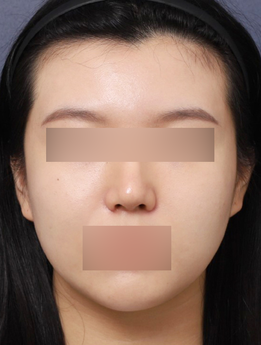 신사역 복코 재수술 전후 : 얄쌍한 콧대로 바뀐 사례 관련 이미지 3