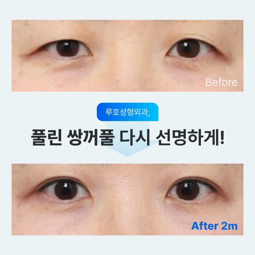 신사역 눈재수술, 풀린 쌍꺼풀 또렷하게 복원한 사례 관련 이미지 1