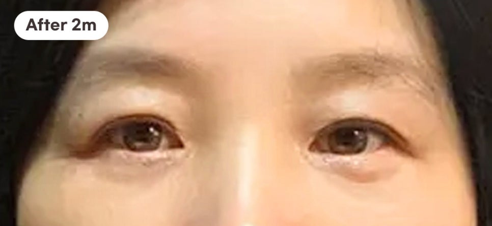 A Case of Correcting Midlife Eyelid Sagging with Upper Blepharoplasty at Sinsa Station image 5