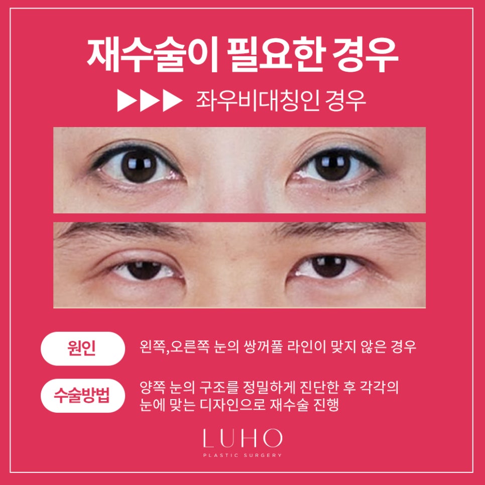 Double Eyelid Revision Surgery at Luho image 5