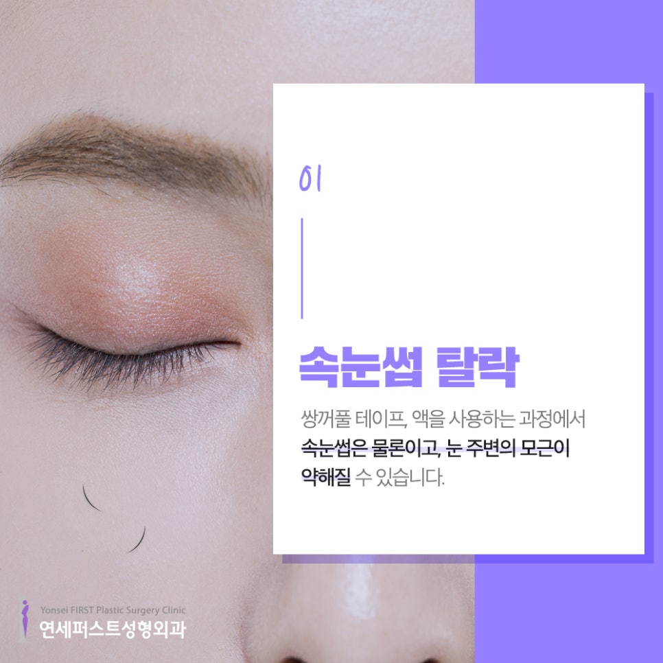 쌍꺼풀액, 쌍꺼풀테이프 사용하면 안되는 이유 (쌍액,쌍테 부작용) 관련 이미지 2