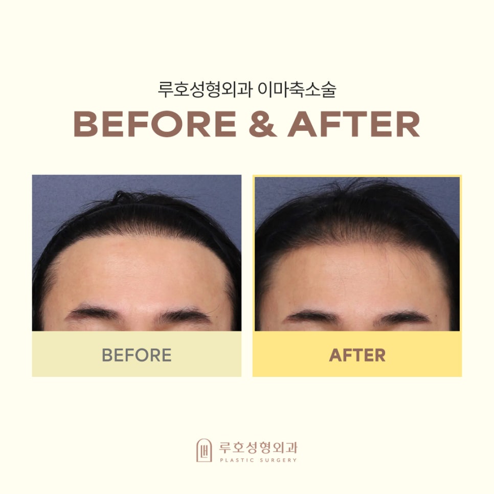 Sinsa Station Forehead Reduction Surgery: Real Before-and-After Review image 1