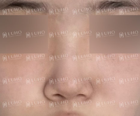 화려하고 또렷한 코 라인으로 개선한 수술 후기 관련 이미지 4