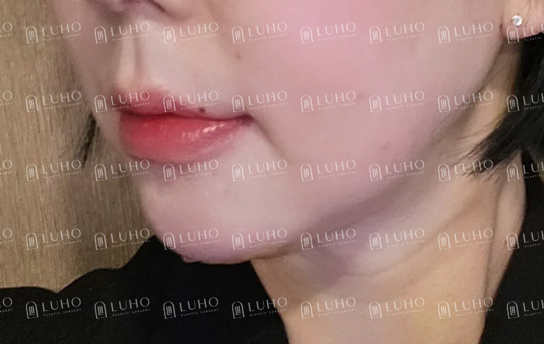 다이어트해도 안 빠지는 턱살, 이중턱 근육 묶기로 달라진 후기 관련 이미지 5