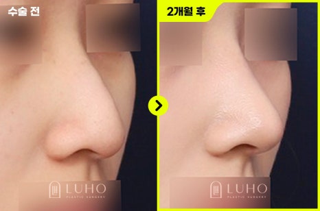 Non-Implant Rhinoplasty at Luho Plastic Surgery near Sinsa Station image 2