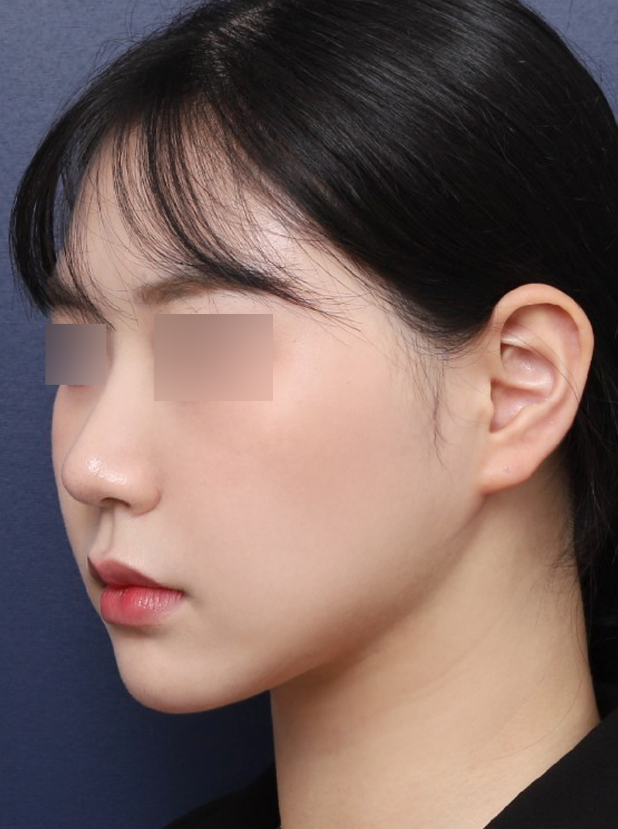 턱라인을 슬림하게 만든 얼굴지방흡입 후기 관련 이미지 5