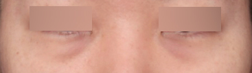 Review of Improvement to a Smooth Under-Eye Area at a Sinsa Station Under-Eye Surgery Clinic image 3