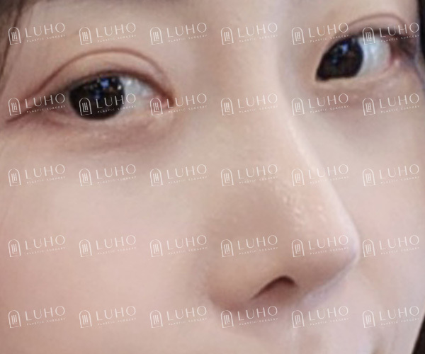A Review of Eye & Nose Revision Surgery That Addressed the Shortcomings of Previous Surgery image 9