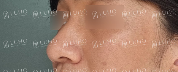 복코와 콧볼을 정리한 남자코수술, 어떤 부분이 바뀌었을까? 관련 이미지 3