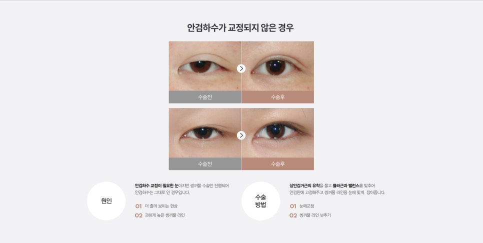 눈 수술법의 종류와 회복기간 #2 관련 이미지 11