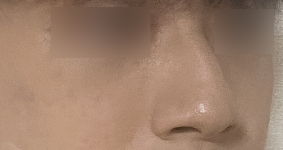 남자코수술, 조화로움을 만드는 원칙이 있습니다 관련 이미지 3