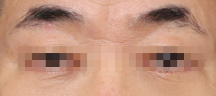 Curious About a Real Case of Lower Blepharoplasty for Under-Eye Sagging at Sinsa Station? image 5