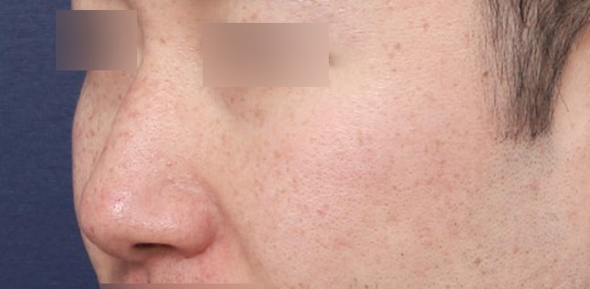 자연스러운 코 개선이 가능한 남자코성형잘하는곳 관련 이미지 2