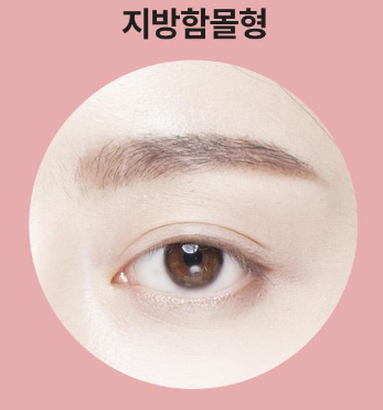 ［루호성형외과］어두운 눈 밑을 환하게-눈밑지방재배치 관련 이미지 11