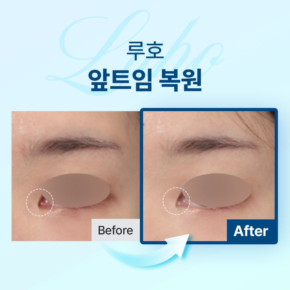A Review of Medial Epicanthoplasty Revision That Restored a Natural Look to the Inner Corners of the Eyes image 1