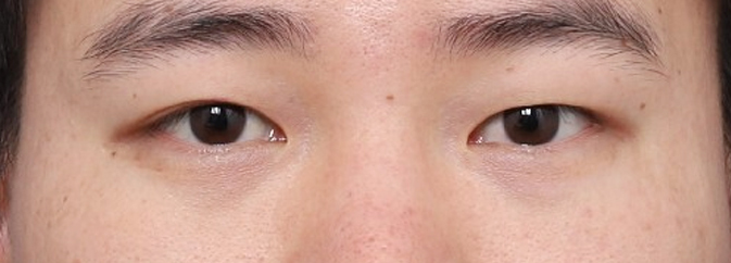 또렷한 눈매로 변한 신사역 남자눈성형 잘하는 곳 후기 관련 이미지 2