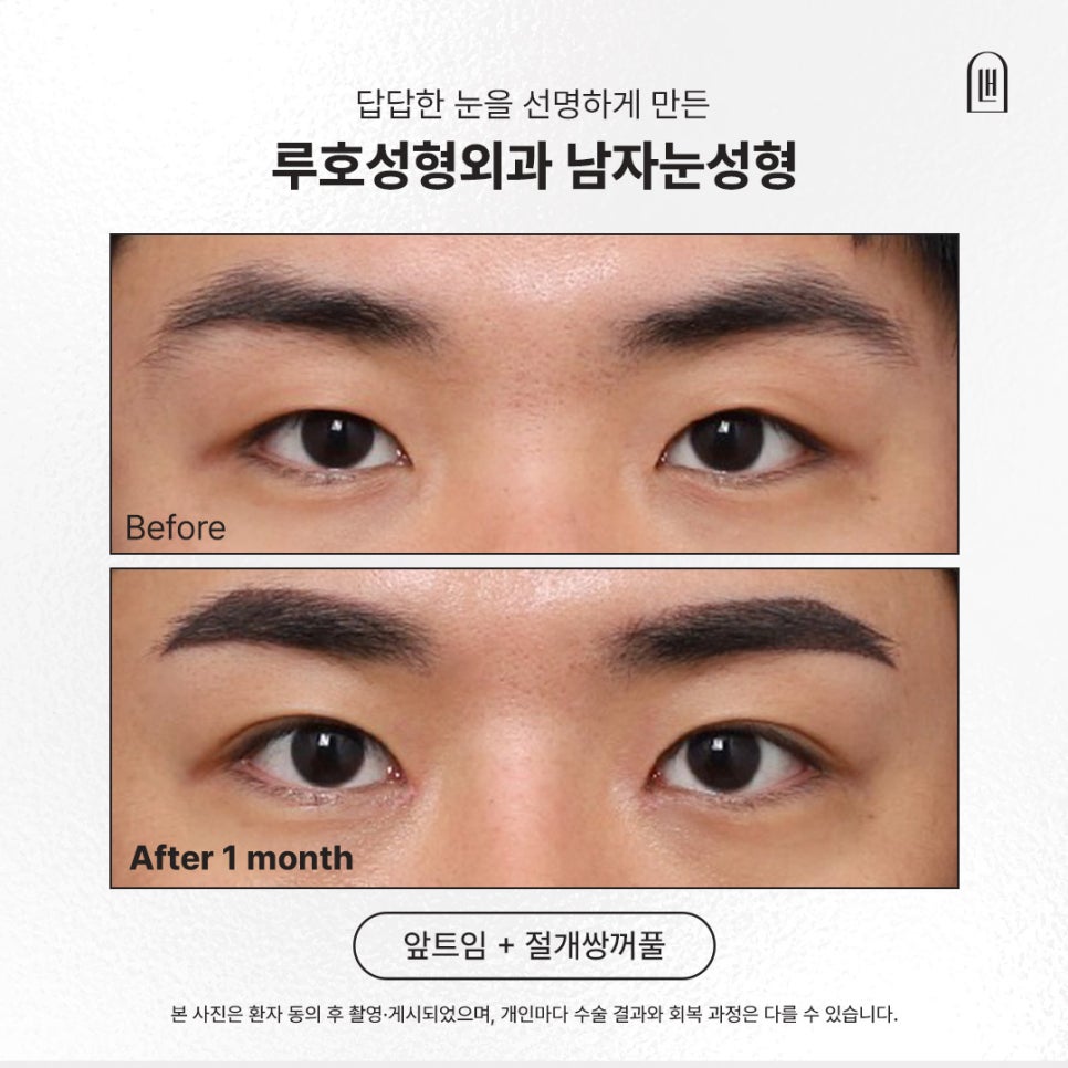 답답해 보이는 눈을 선명하게 만든 신사역남자눈성형 전후 관련 이미지 1
