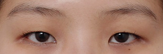 Sinnonhyeon Station Double Eyelid Revision Surgery for Faded Lines: Sharpening a Loose Line image 2