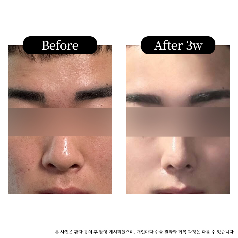 Real Before-and-After Review of Male Rhinoplasty at Luho Plastic Surgery Near Sinsa Station image 2