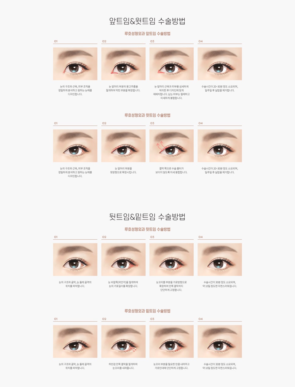 눈 수술법의 종류와 회복기간 #1 관련 이미지 8