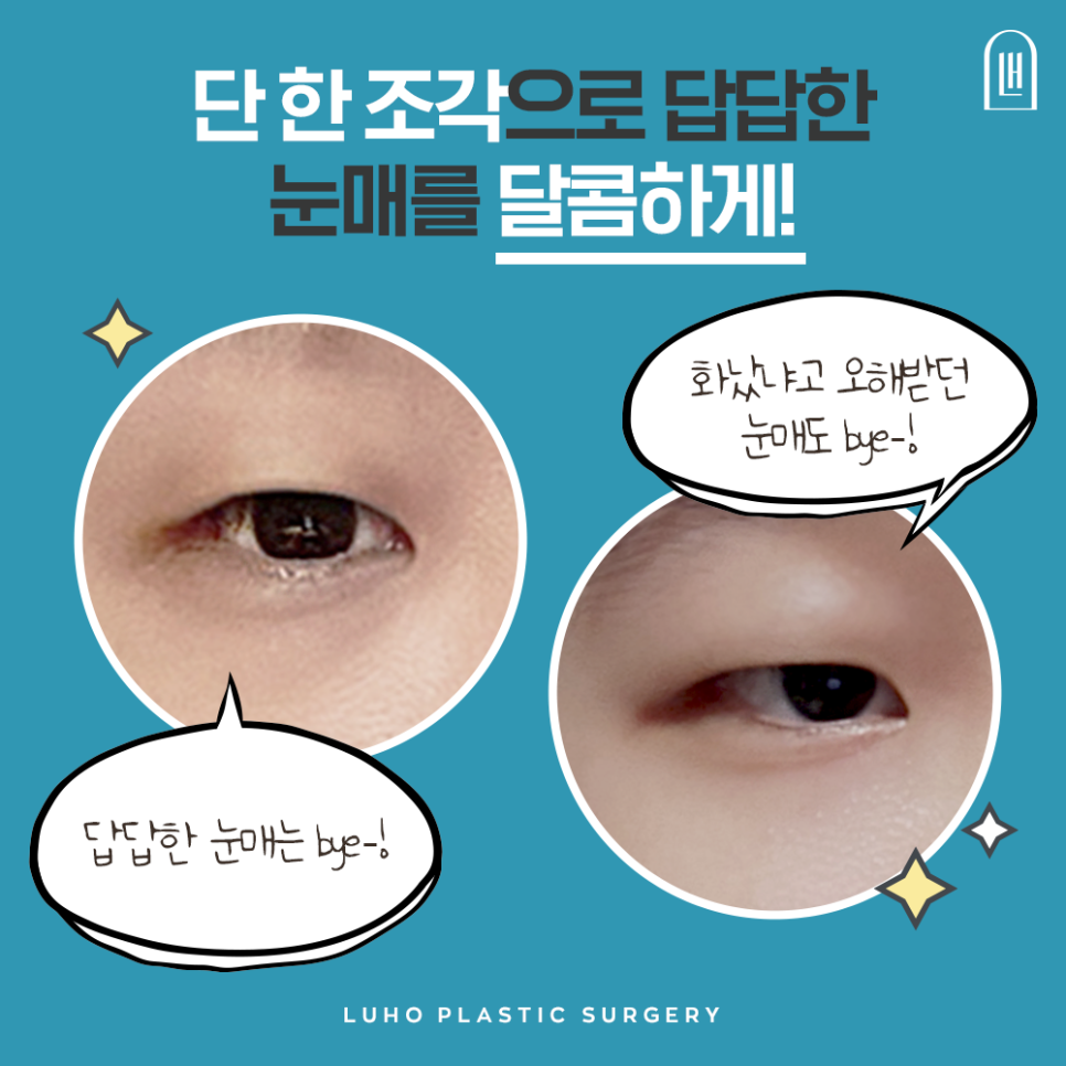 [루호성형외과] 작은 눈도 종류가 있다? 이런 분들은 꼭 트임 눈성형 하세요 관련 이미지 8