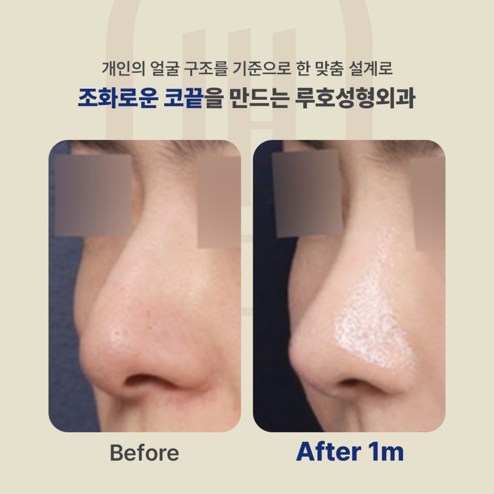 A Rhinoplasty Review for the Nasal Tip at Sinsa Station That Changed a Blurry Impression image 1