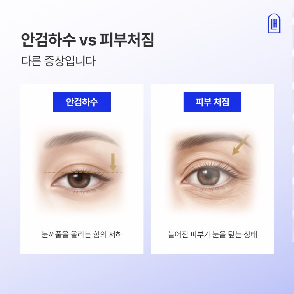 강남 신사역 안검하수 눈매교정 전후, 또렷함을 결정짓는 기준은? 관련 이미지 2