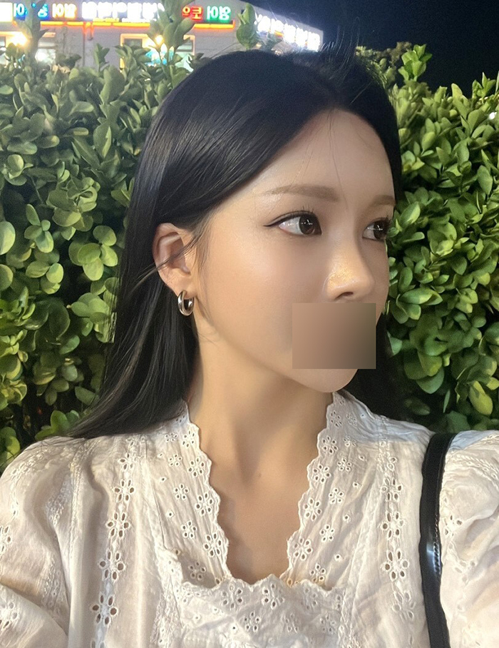 신사 얼굴지방이식 효과, 전후 비교 후기 관련 이미지 4