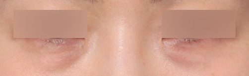 A Review of Under-Eye Surgery Near Sinsa Station That Changed My Shadowed Impression Caused by Dark Circles image 3