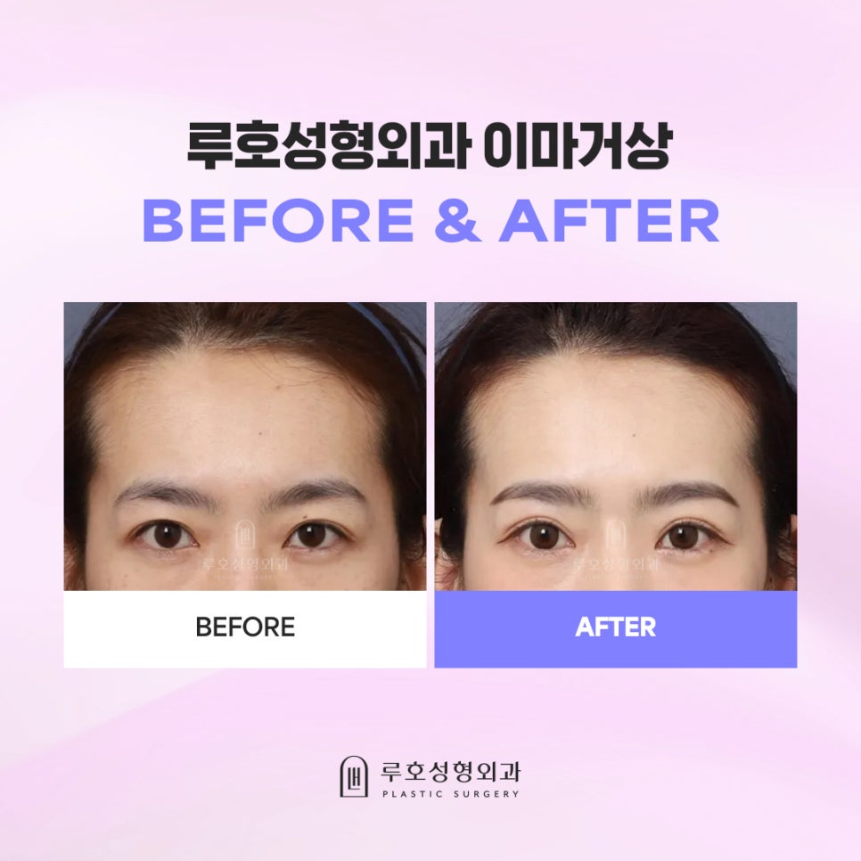 처진 눈썹 바꿔놓은 신사역 이마거상 후기 관련 이미지 1