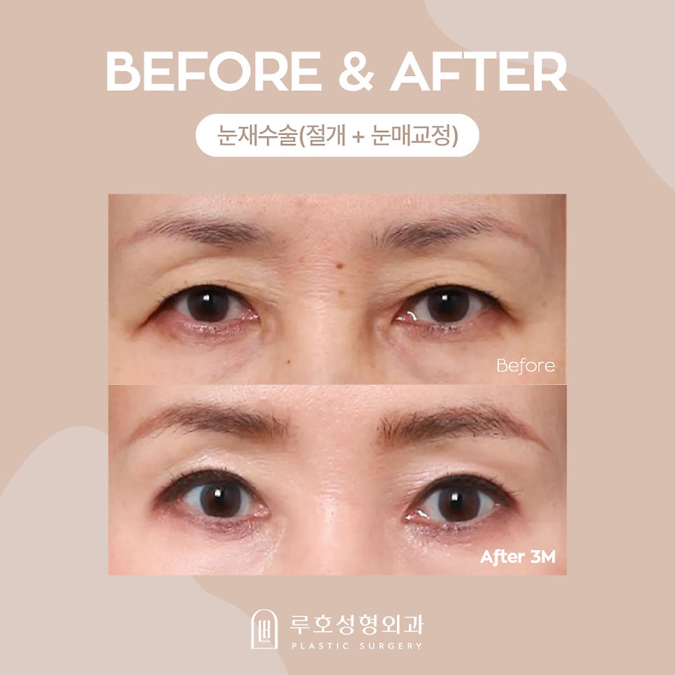 Middle-Aged Eye Surgery at Luho Plastic Surgery, Sinsa Station image 2