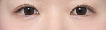 Before-and-After Review of Ptosis Correction with Double Eyelid Surgery Near Sinsa Station image 4