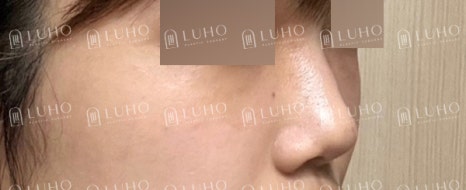 화려하고 또렷한 코 라인으로 개선한 수술 후기 관련 이미지 6
