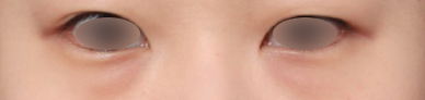 Dark Shadows Under the Eyes, a Different Look After Under-Eye Fat Repositioning Surgery at Sinsa Station image 3