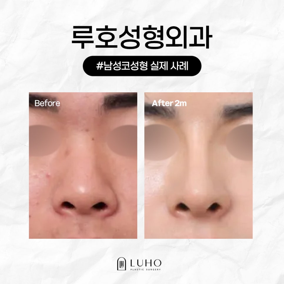 A Real Review of Men’s Rhinoplasty at Sinsa Station That Completed a Masculine Line image 1