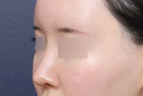 Sinsa Station Nose Revision Surgery, Real Results Correcting a Long Nose image 5