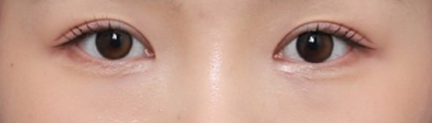 수술 후기로 파악하는 쌍꺼풀 잘하는 병원 기준 관련 이미지 4