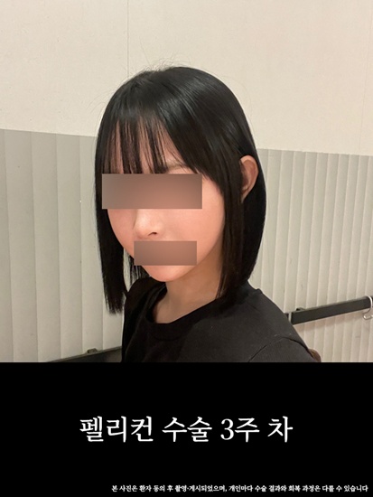 턱과 목의 경계를 찾아주는 압구정 펠리컨 수술 전후 비교 관련 이미지 4