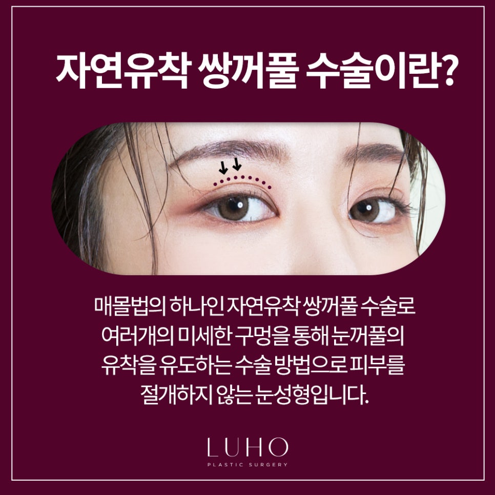자연유착쌍꺼풀수술,내가 원하는 눈으로 루호에서 관련 이미지 2