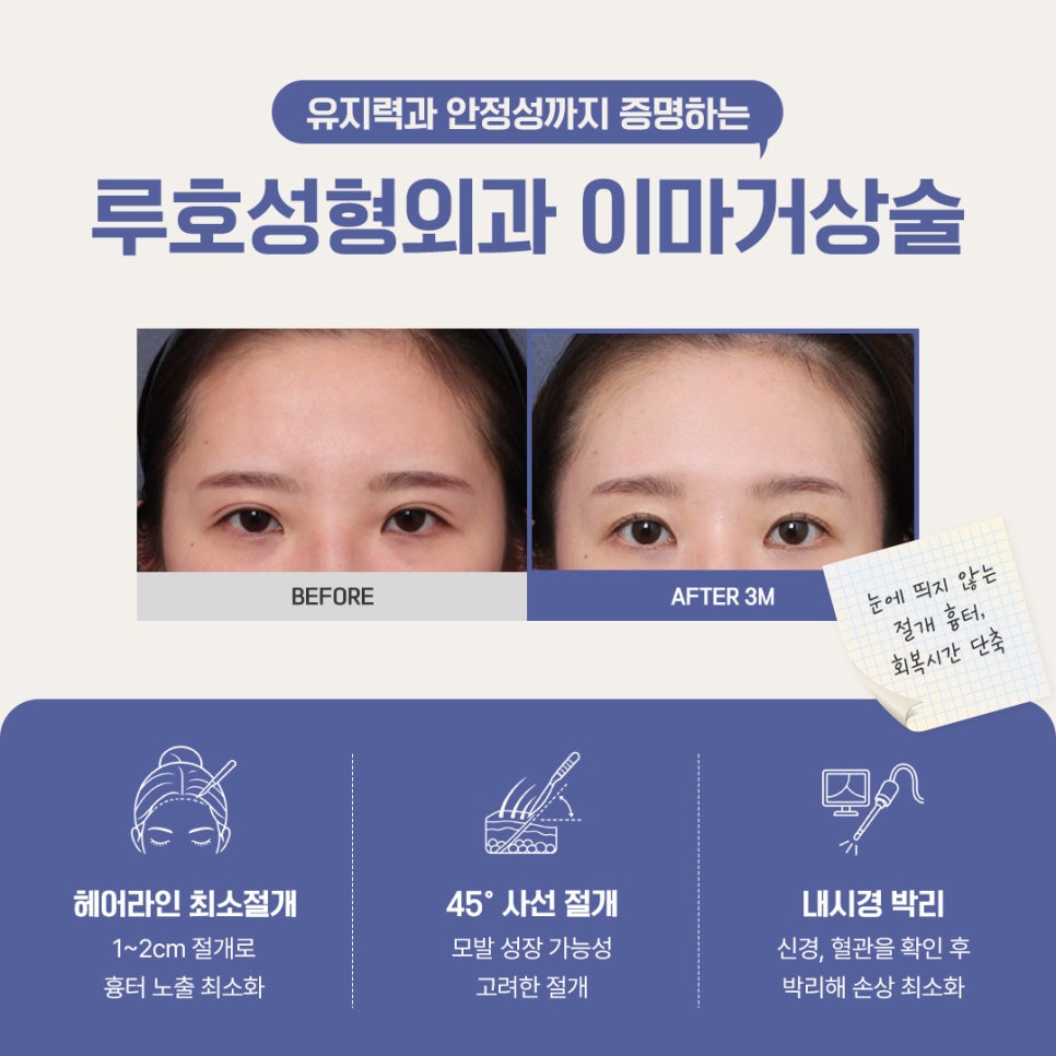 A Brighter Impression with an Endoscopic Forehead Lift to Correct Drooping Eyebrows image 3