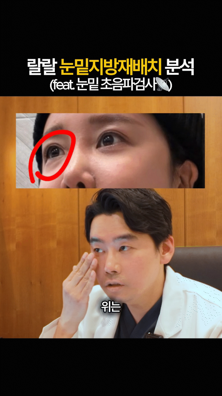 Before and After Undereye Fat Repositioning at Sinsa Station: Why the Undereye Appearance Changed image 4
