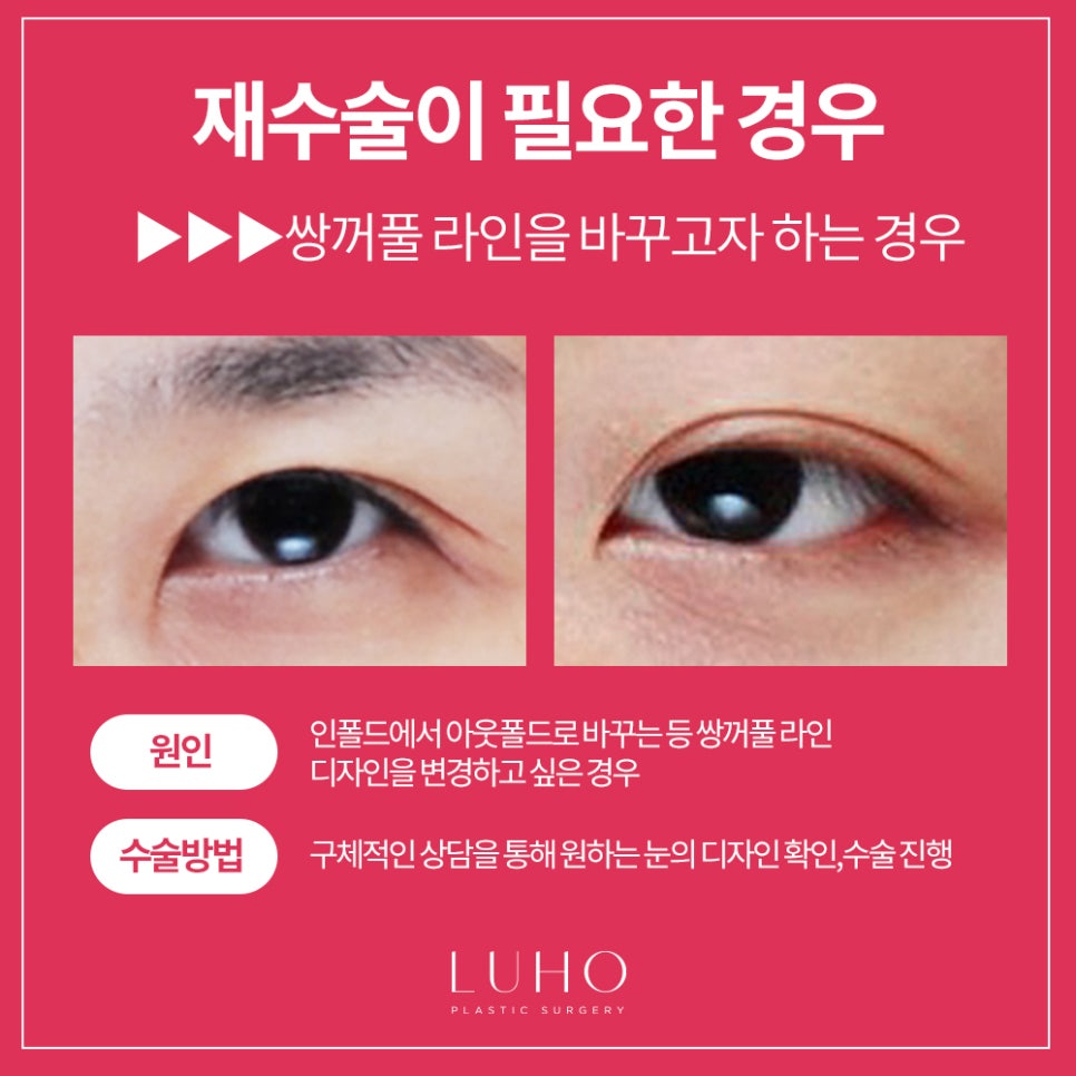 Double Eyelid Revision Surgery at Luho image 6