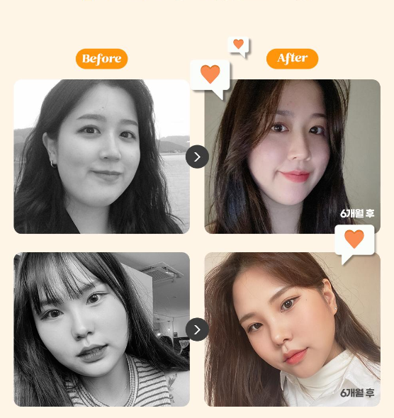 [Luoho Plastic Surgery] Slim V-Line Face Liposuction image 2