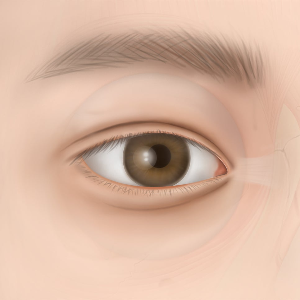 What Are the Key Points Before and After Eyelid Correction at Apgujeong Station? image 5