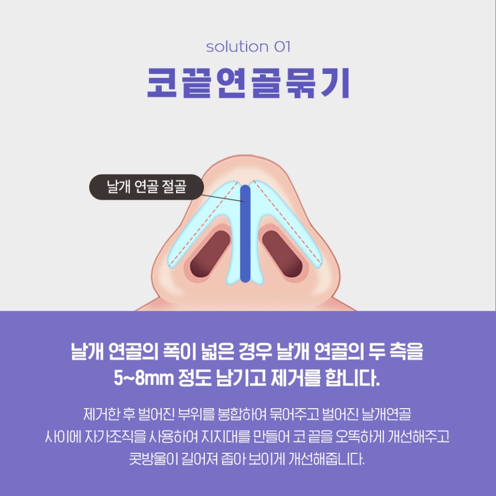 If You’re 고민 About Bulbous Nose Surgery, You Need to Know the Surgical Methods by Type image 3