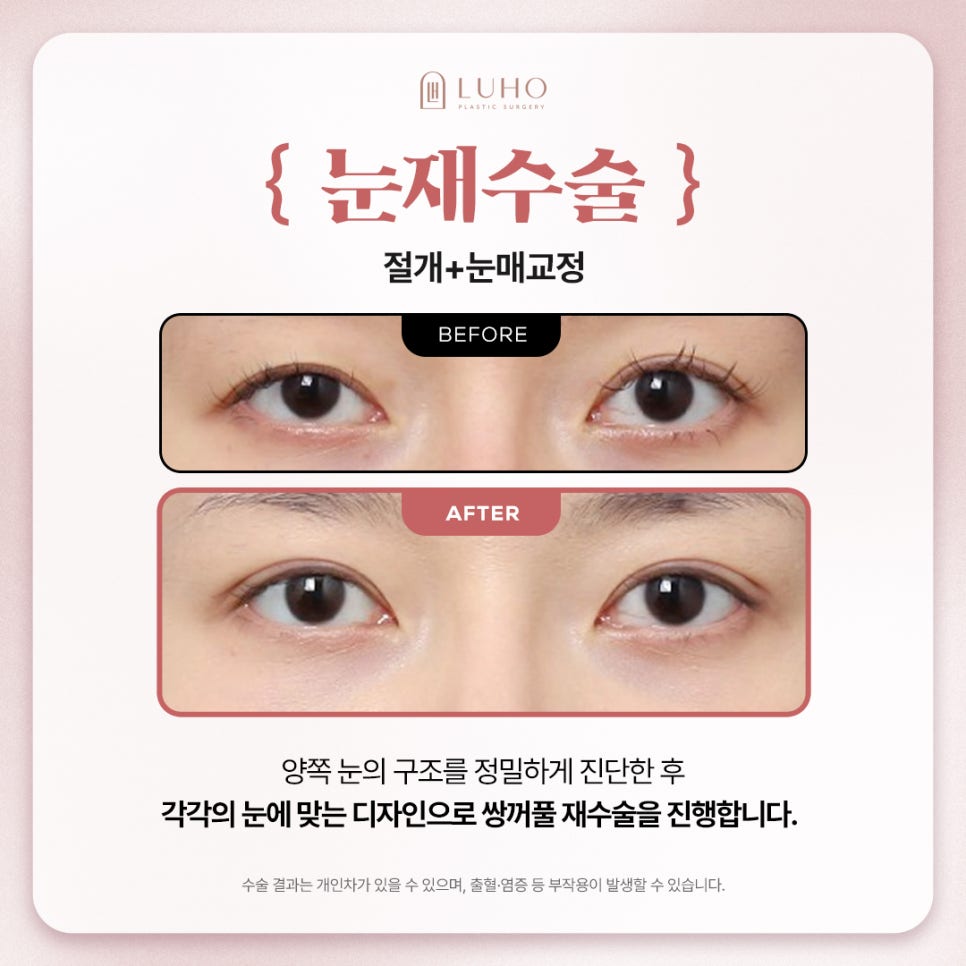 소세지 눈, 비대칭 라인 해결하려면? 관련 이미지 2