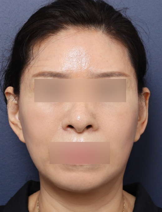 신사역 60대 안면거상 피부가 아닌 관련 이미지 5
