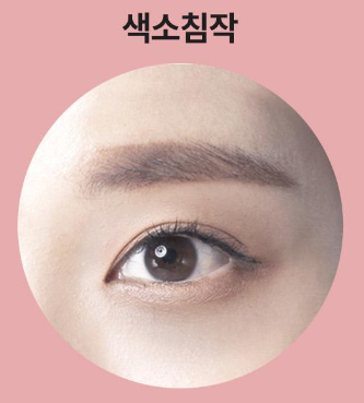 ［루호성형외과］어두운 눈 밑을 환하게-눈밑지방재배치 관련 이미지 10