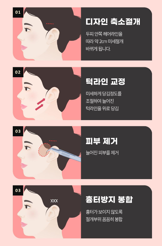 The Advantages of Lifting at a Glance: Ruho Plastic Surgery Mini Lifting image 9